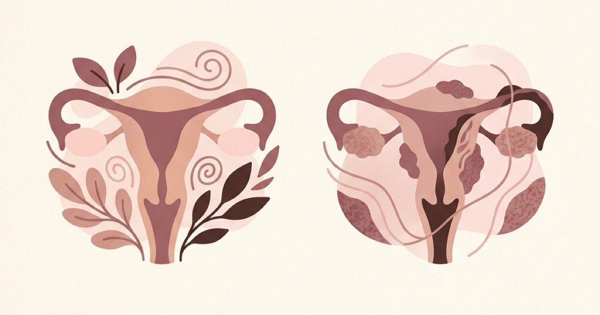Adenomyosis vs Endometriosis: Differences & Overlap
