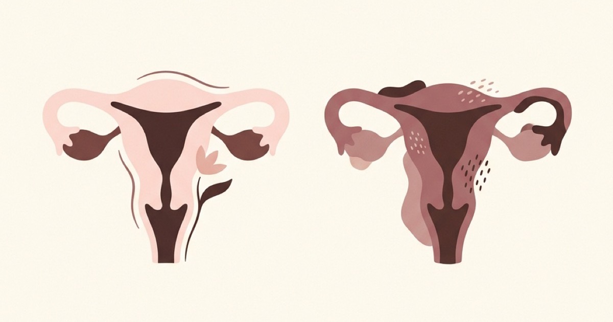 Endometriosis vs Fibroids: How to Tell Them Apart